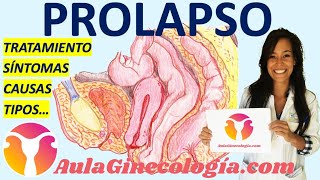 PROLAPSO DE ÓRGANOS PÉLVCOS SÍNTOMAS TIPOS EXPLORACIÓN TRATAMIENTO Ginecología y Obstetricia [upl. by Freudberg]