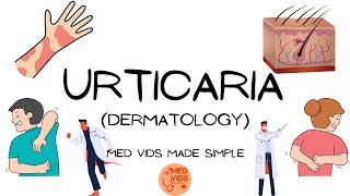 Urticaria  Dermatology Pathophysiologyclinical featuresdiagnosistreatment MedVidsMadeSimple [upl. by Yerkovich666]