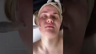 Our Collagen Stimulating Biologique Recherche Microneedling Facial [upl. by Leund288]