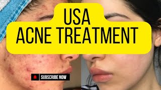 Top Acne Treatment Tips for Clear SkinUnited States Acne Treatment [upl. by Elaina]