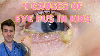 Doctor explains 4 causes of eye pus discharge or sticky eyes in kids  Doctor ODonovan [upl. by Aineg]