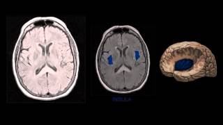 NEUROIMAGEM  Anatomia Cerebral na Ressonância Magnética [upl. by Arria]