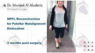 MPFL Reconstruction for Patellar Malalignment Dislocation  3 months post surgery [upl. by Norward]