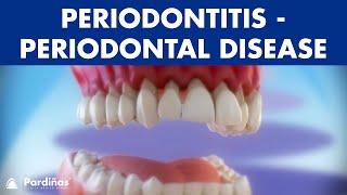 Gum disease  Periodontitis  Periodontal Disease © [upl. by Notaek]