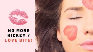 3 Easiest Home Remedies to Get Rid of HickiesLove Bites Fast [upl. by Lebezej]