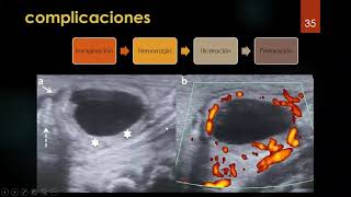 MI quiste de duplicación Divertículos Divertículo de meckel Adenitis mesentérica 2da parte [upl. by Nosemaj194]