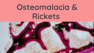 Osteomalacia and Rickets  Pathology mini tutorials [upl. by Aicertap911]