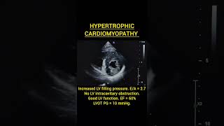 Hypertrophic Cardiomyopathy echocardiomyopathyhypertrophymitralcardiacheartfailurecardiology [upl. by Minni]