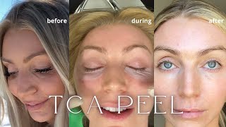 TCA PEEL  PROCEDURE AND RECOVERY PROCESS  BEFORE AND AFTERS  QampA [upl. by Hniht493]