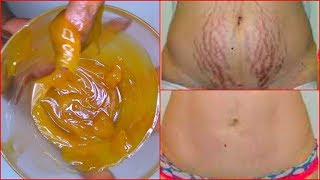 REMOVE STRETCH MARKS FAST HOW TO GET RID OF STRETCH MARKS EFFECTIVELY  Khichi Beauty [upl. by Waugh]