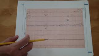 Práctica de Hipnograma y registro del ciclo SueñoVigilia  Parte 2 [upl. by Nnav]