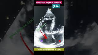 Atrial septum Aneurysm l jump rope sign in Echo echo shorts [upl. by Ainoyek]