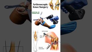 Arthroscopic Knee Surgery medical animation 3d short BiologywithAliya [upl. by Enenaj]