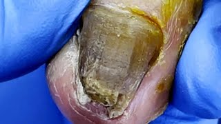 Pedicure Tutorial：Huge toenail trimming，severe onychomycosis【Pedicure Master Lin Jun】 [upl. by Hnad47]