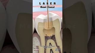 Root Canal Treatment with Laser Explanation about teeth Bacteriadentist teeth rootcanal [upl. by Yentirb]