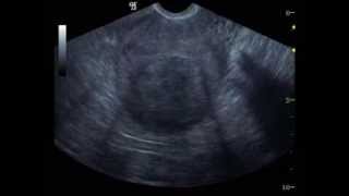 Myoma Uteri Ultrasound 11 [upl. by Morley772]