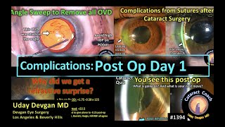 CataractCoach 1394 postop day one complications after cataract surgery [upl. by Olympe222]