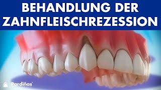 Zahnfleischrückgang – Behandlung der Zahnfleischrezession © [upl. by Jerad]