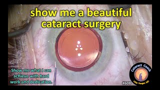 show me a beautiful cataract surgery [upl. by Lainahtan285]