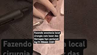 Fazendo anestesia local cirurgia Laser verrugas anais [upl. by Euphemiah420]