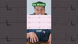 Recognizing De Winter Pattern A Critical ECG Sign of LAD Occlusion [upl. by Hinkel]