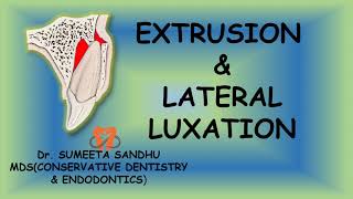 Extrusion and lateral luxation of teeth  Management Luxation injuries [upl. by Alyss]