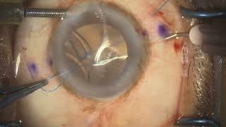 Dr Magan’s Belt Loop technique for scleral Refixation of luxated IOLs [upl. by Higbee]