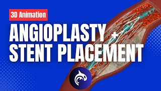 Angioplasty and Stent Placement  3D Animation [upl. by Cohlier]