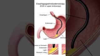 Esophagogastroduodenoscopy is a diagnostic endoscopic procedure gastroesophageal esophageal yt [upl. by Tada82]