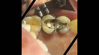 Pulpotec Retreatmentالكربولة endodontics [upl. by Teri376]