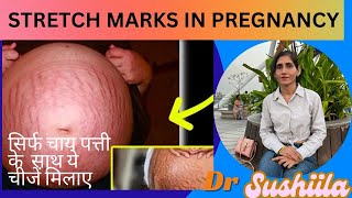 Remove Stretch Marks at Home  Pregnancy Ke Stretch Marks Hataye Naturally  stretchmarks [upl. by Alegre]