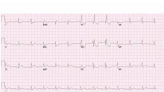 Inferior Posterior STEMI Missed by Computer [upl. by Novaat698]