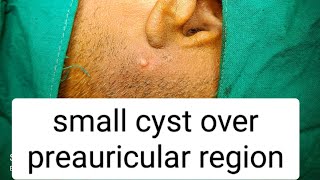 small cyst over preauricular regioncystcyst removal surgerycyst extraction surgerydr youtube [upl. by Ethelinda993]