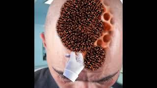 Asmr treatment maggots head  removal of severely injured infected  2d animation [upl. by Arua]