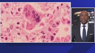 Person with measles travels through DC airports health experts warn of possible exposure [upl. by Liebman]