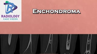 Enchondroma [upl. by Biron]