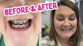 Mom Gets Braces Off  Before and After  Clear Retainers  Crystal Lopez [upl. by Paterson486]