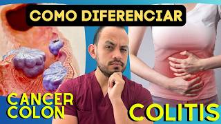 Diferencias en los Síntomas de Cáncer de Colon vs Colitis Estudios que se pueden realizar [upl. by Enelcaj719]