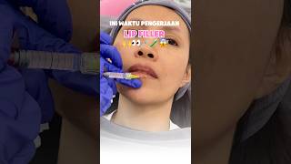 Lip Filler Treatment lipfiller fillerbibir trending trendingshorts [upl. by Dysart]