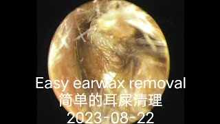 Easy earwax removal简单的耳屎清理20230822 [upl. by Hylan]