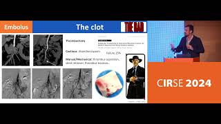 511 3 Endovascular management Mesenteric Ischemia [upl. by Corri]