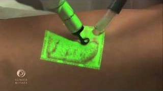 Augmented Reality VeinViewer technology on varicose veins treatment Novo Tratamento Varizes [upl. by Yrailih]