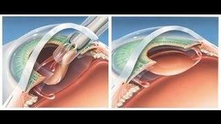 Cataract Surgery Animation [upl. by Dotty]