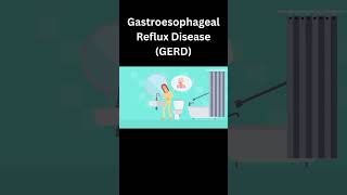 Gastroesophageal Reflux Disease GERD [upl. by Murielle568]