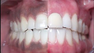 How to get rid of DARK GUMS causes amp treatment for blackgums [upl. by Philps]