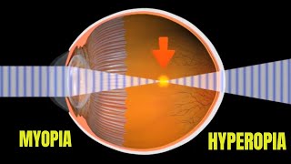 Myopia and Hyperopia [upl. by Edveh]