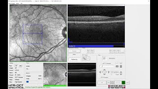 Recorded Webinar OCT LIVE Virtual Workshop  OCT Angiography Module [upl. by Dorrahs]