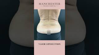 Vaser Liposuction Before and After Results by Mr Anuj Purbey [upl. by Akered]