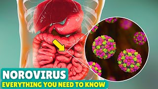 Norovirus Explained Causes Symptoms and How to Recover Fast [upl. by Donaldson]