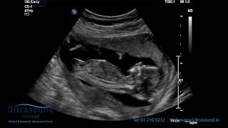 Scan of the Week 15 Weeks Pregnant The Advanced Early Ultrasound [upl. by Kciderf290]